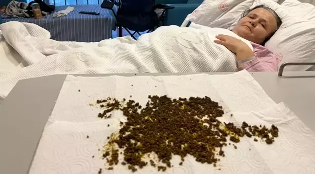 He went to the hospital with complaints of abdominal pain, and 20,000 stones were removed from his gallbladder.