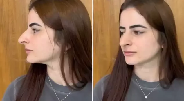 She eagerly underwent a nose job, but it ended in scandal.