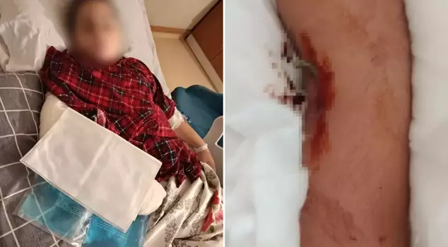 9-летний ребенок отомстил, сломав руку 8-летнему ребенку.