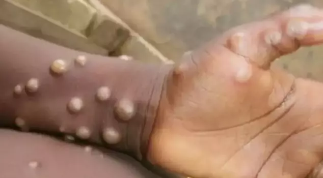 The first case of M flower was detected in Madagascar.