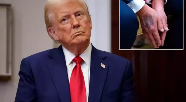 Trump explained the reason for his bruises for the first time.