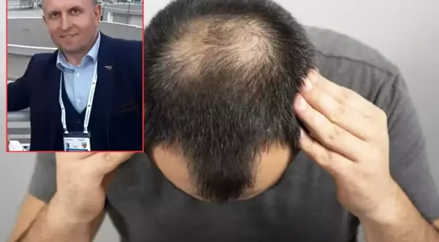 He fainted during the hair transplant and lost his life.