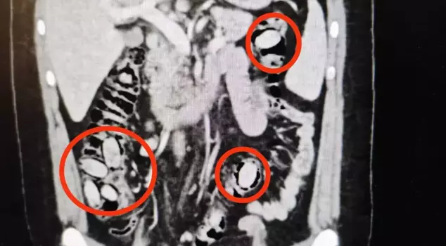 В Эскишехире шокировало то, что вышло из живота человека, которого остановила полиция.