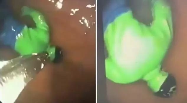 В Индии из живота ребенка вышел 