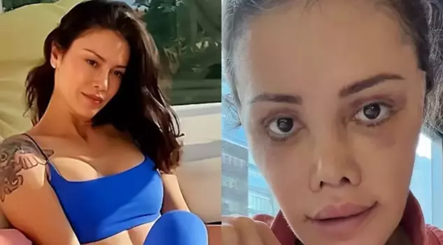 Didem Ceran, who underwent a face transplant, looks amazing.