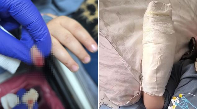 A child's finger was severed when it got caught in an escalator at the shopping mall.