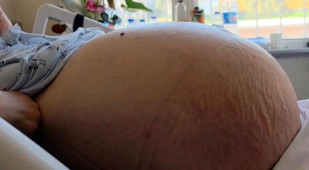 حالة حيرت حتى الأطباء! ظنها إمساكًا لكن بطنه انتفخ حتى وصل إلى أنفه