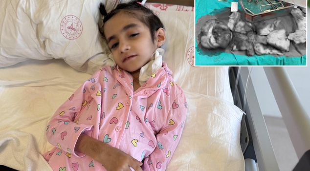 أول في العالم! تم استئصال ورم وزنه 3 كيلوغرامات في عملية استغرقت 6.5 ساعات