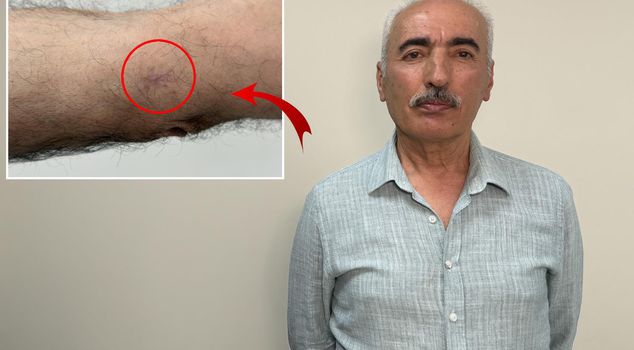 Рана длиной 1 сантиметр на руке оказалась раком