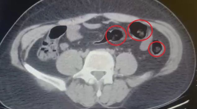 تم استخراج نصف كيلوغرام من المخدرات من معدته وأمعائه