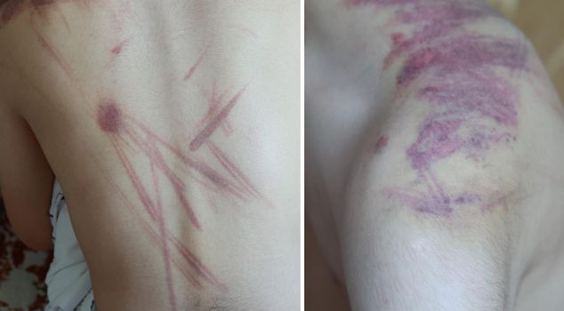 When she saw the marks on her son with Down syndrome, she first went to the hospital and then to the courthouse.