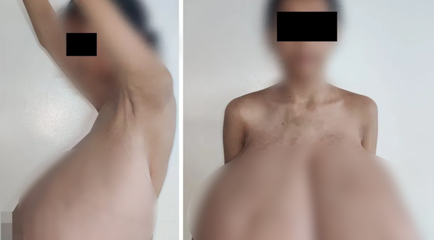 بدأت في سن الثالثة عشرة! بلغ حجم ثدييها ربع وزن جسمها