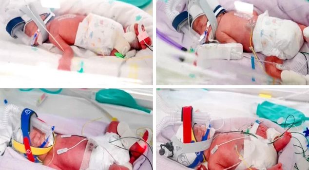 In Australia, a woman gave birth to identical quadruplets as a result of a natural pregnancy.