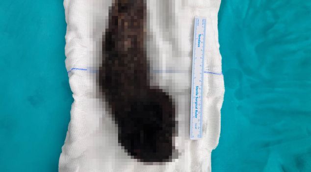 How is this possible? Look at what came out of a 15-year-old's stomach.