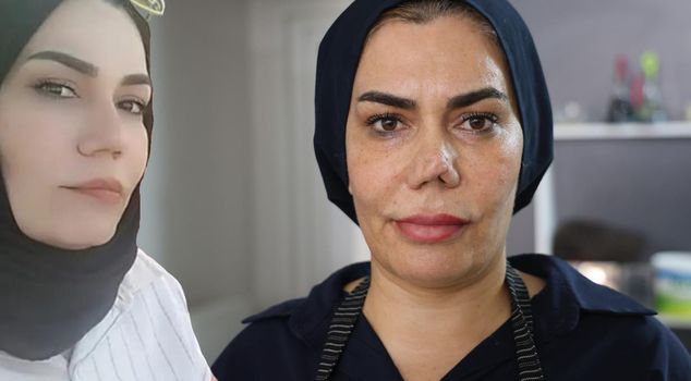Rhinoplasty ended in disaster: The woman's life turned into a nightmare