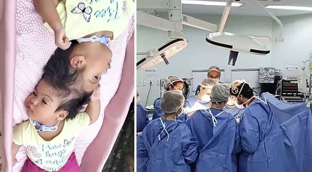 Sad news about conjoined twins: Their hearts stopped 14 minutes apart