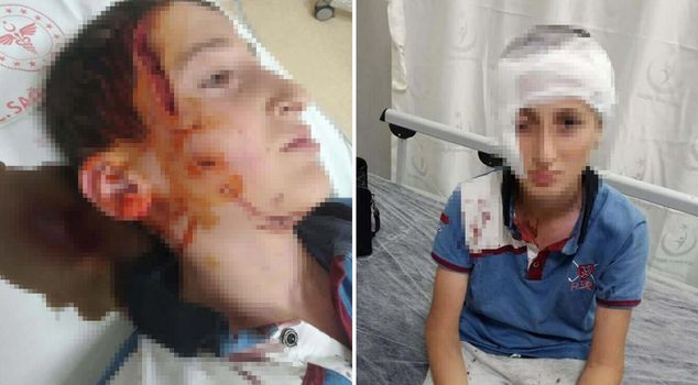 الطفل الذي ترك هجوم الكلب ندوبًا دائمة في وجهه حصل على تعويض قدره 1.2 مليون ليرة تركية