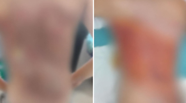 في أرنافوتكوي، ادعاء تنمّر بين الأقران: أحرقوا ظهر طفل يبلغ من العمر 12 عامًا بالكولونيا