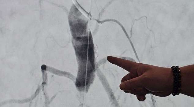 They were preparing for surgery! The cause of 1 year of pain turned out to be a 100% blocked blood vessel