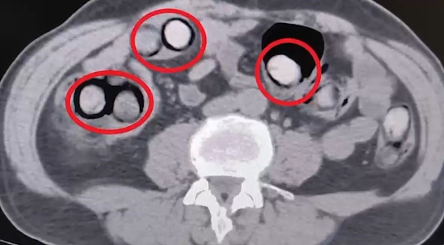It was revealed on X-ray! 101 pieces of methamphetamine in the stomach and intestines of a bus passenger in Tatvan.