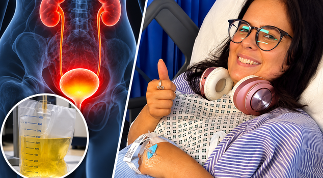 They have been unable to urinate normally for 2.5 years: 1 liter of urine was drained from their bladder.