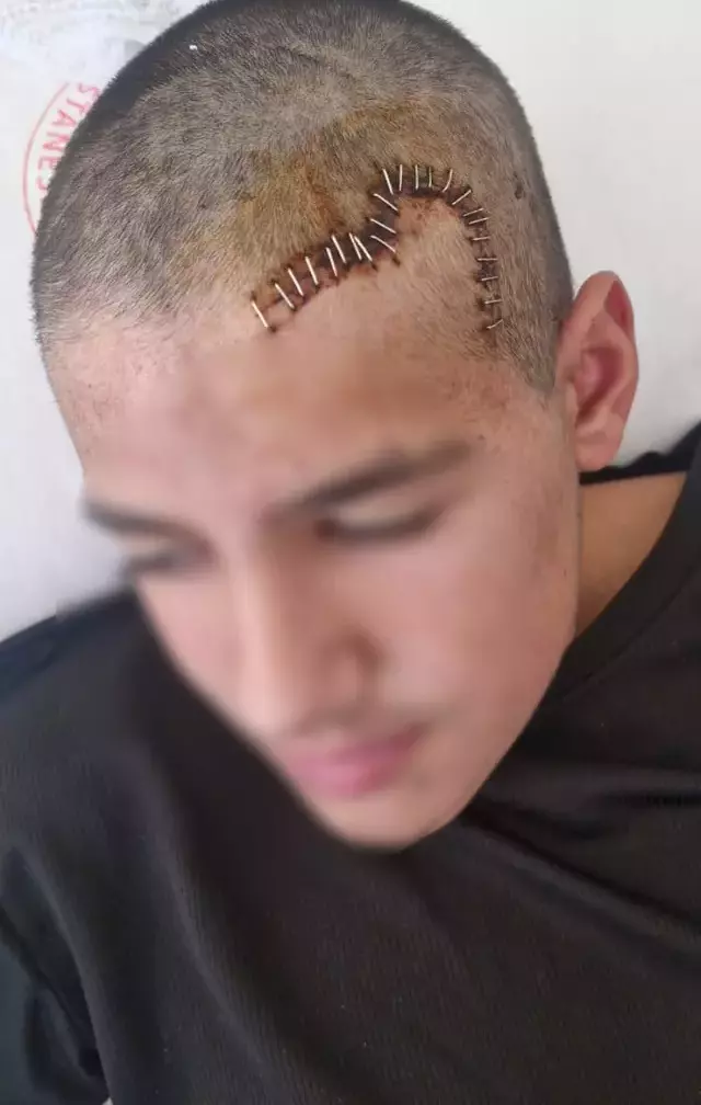 Akran zorbalığına maruz kalan 13 yaşındaki çocuğun kafatası titanyum parçalarıyla yeniden oluşturuldu