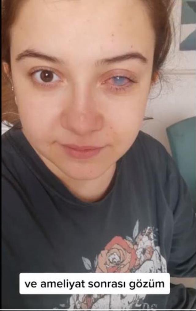 Akşam lensle uyuyan genç kız, sabah kalkıp aynaya baktığında dehşeti yaşadı