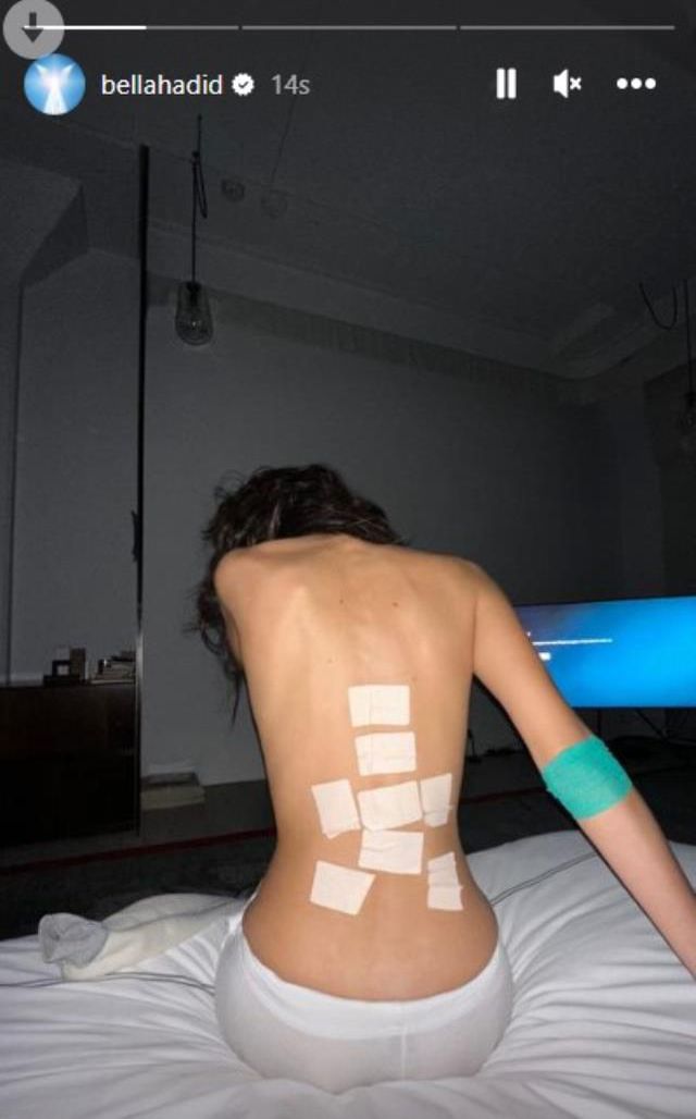 Lyme hastalığıyla mücadele eden Bella Hadid, moraran vücudunu paylaştı
