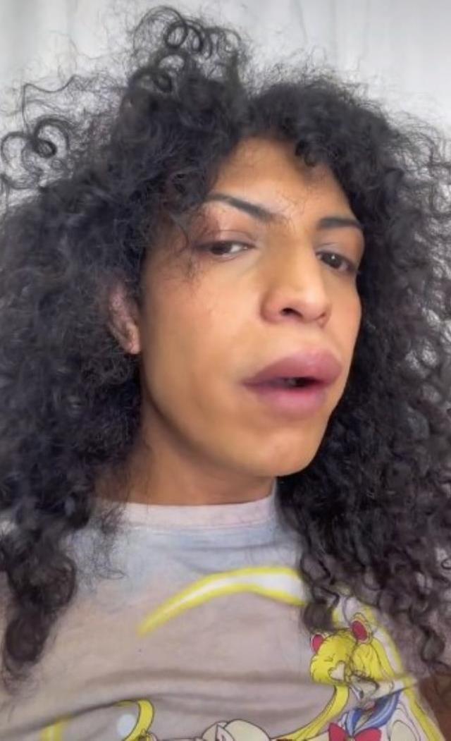 Sevgilisiyle öpüştükten sonra dudağı şişen kadın hastaneye zor yetişti