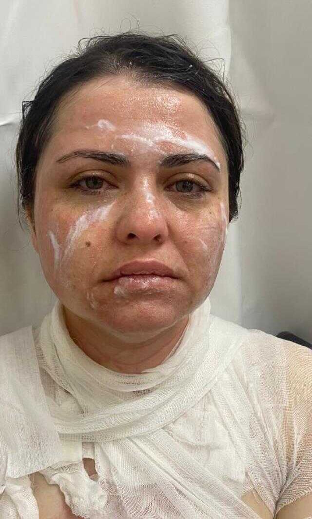 Eski kocası yolunu kesip 'Güzelliğine mi güveniyorsun?' diyerek yüzüne kimyasal madde fırlattı