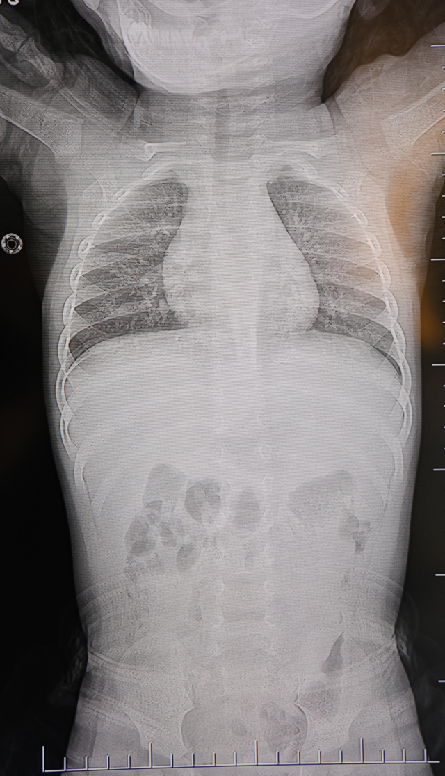 1 yaşındaki bebek sırtüstü yatırıldıkça ağladı! Gerçeği gören aile şoke oldu