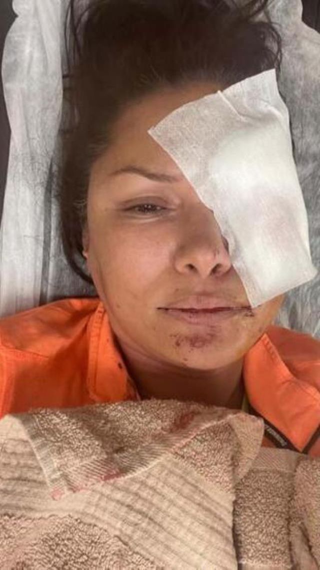Köpek saldırısında yüzü parçalanan Tuğba Altıntop yaşadıklarını anlattı: Her yer kan revan içindeydi