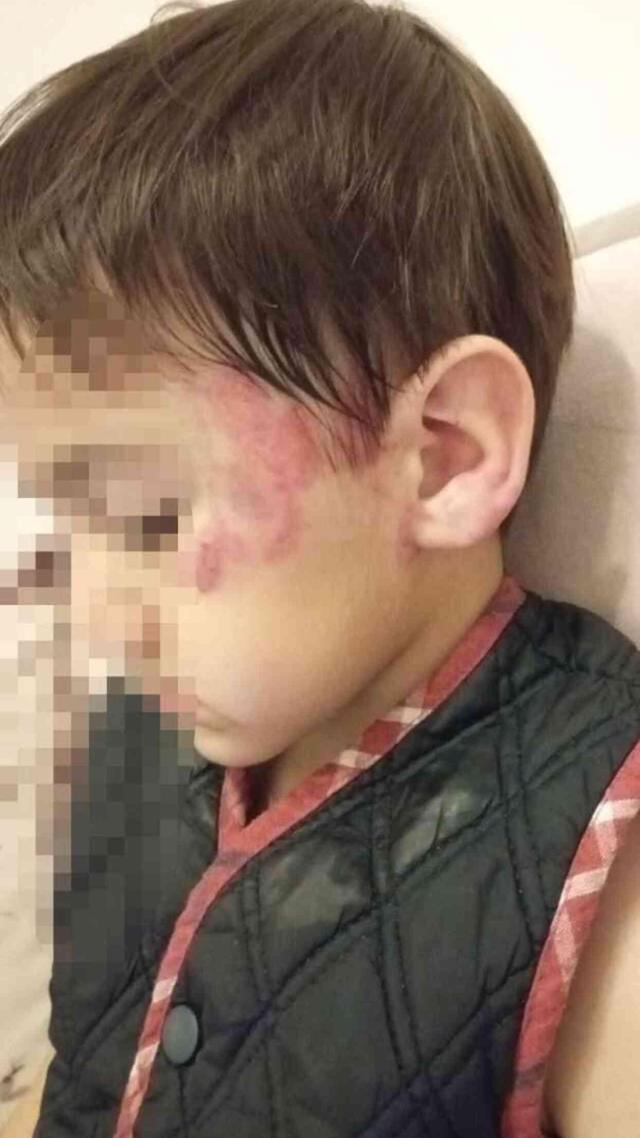 Anaokulunda 4 yaşındaki çocuk 3 yaşındaki çocuğu uyurken 13 yerinden ısırdı; aile şikayetçi oldu