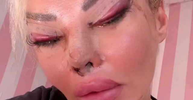 Estetik bağımlısı fenomen ölümden döndü