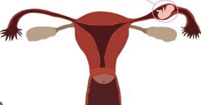 Dış gebelik nedir? Dış gebelik belirtileri neler?