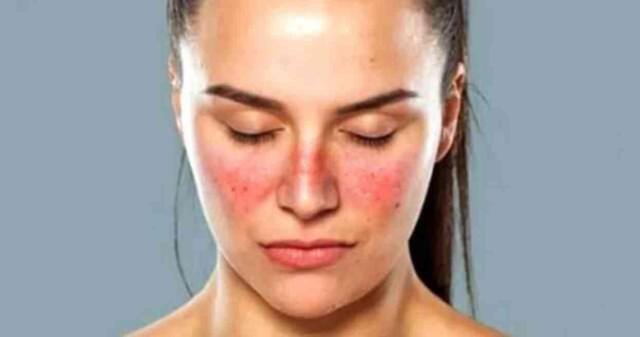 Kelebek Hastalığı nedir? Kelebek Hastalığı belirtisi nedir? Hangi bölüm bakar?