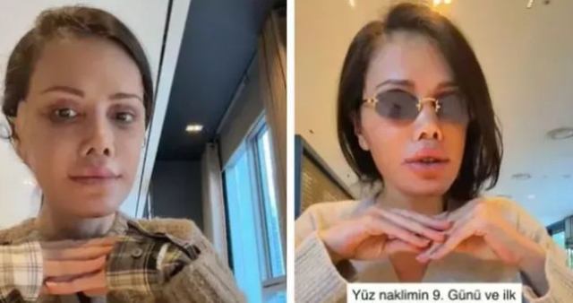 DİDEM CERAN'IN SON HALİ: Didem Ceran yüz nakli mi oldu, son hali nasıl?