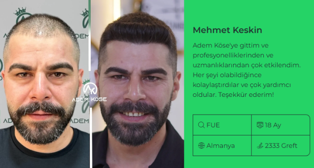 En İyi Saç Ekimi Merkezi Nasıl Seçilir? Adem Köse ile Doğal Sonuçların Peşinde