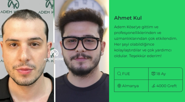 En İyi Saç Ekimi Merkezi Nasıl Seçilir? Adem Köse ile Doğal Sonuçların Peşinde