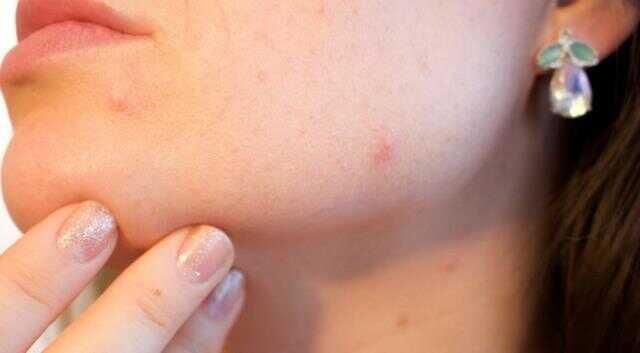 Rüyada sivilce görmek ne anlama gelir? Rüyada yüzde sivilce görmek nedir? Rüyada yüzde sivilce çıktığını görmek ne demek?