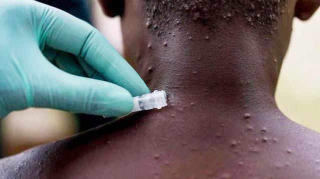 Ülke ülke yayılan maymun çiçeği virüsü nasıl bulaşıyor, belirtileri neler? işte tüm merak edilenler