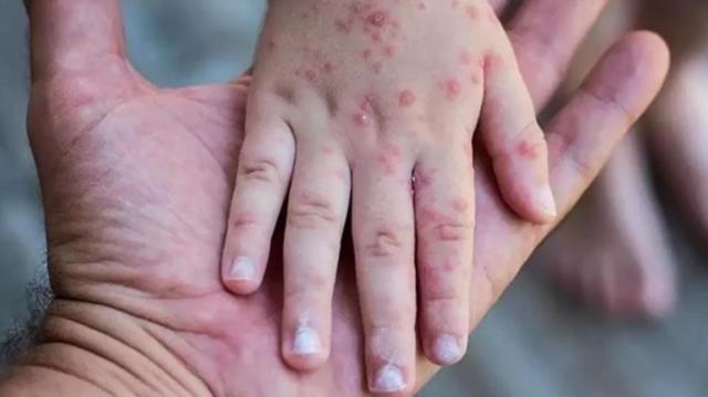 Uşak Sağlık Müdürlüğünden 'Bir kişide maymun çiçeği virüsü görüldü' iddialarına yanıt: Test sonucu negatif çıkmıştır