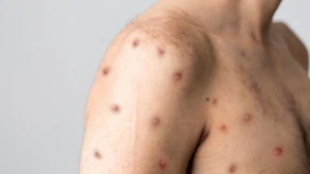 Son Dakika: Bakan Koca kötü haberi verdi! Türkiye'de ilk maymun çiçeği vakasına rastlandı