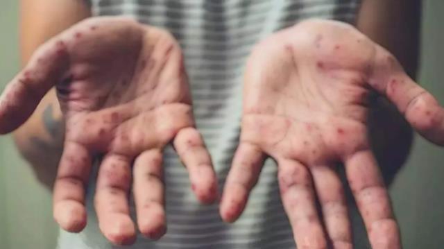 Türkiye'de ilk vakanın tespit edildiği maymun çiçeği virüsünün belirtileri neler? Hastalık nasıl bulaşır? İşte yanıtları