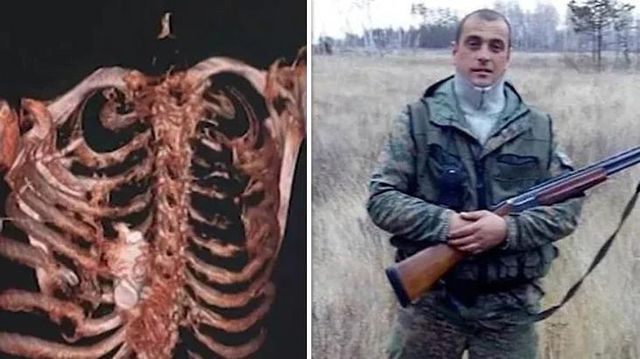 Patlamamış el bombası Rus askerin göğüs kafesine sıkıştı