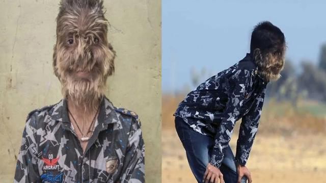 Hastalığı yüzünden kurt adama dönüştü! Mikrofon uzattılar, anlattıkları ibretlik