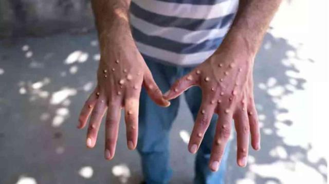 524 kişi can verdi! DSÖ, Maymun çiçeği virüsünü uluslararası halk sağlığı acil durumu olarak ilan etti