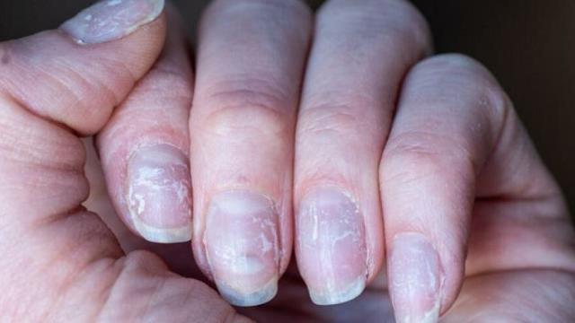 Omicron varyantının yeni belirtisi ortaya çıktı! Tırnak kökleriniz mavi, mor ya da griyse hemen test olun