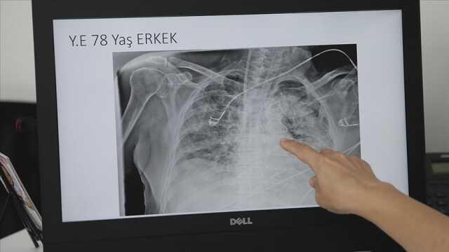 Pnömoni nedir, tedavisi nelerdir? Pnömoni aşısı, etkenleri, çeşitleri nedir? Zatürre nedir, tedavisi nasıl yapılır? Zatürre nedir, tedavisi var mıdır?