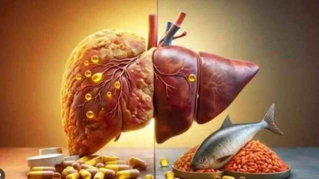 KARACİĞER YAĞLANMASI NEDEN OLUR? Karaciğer yağlanması belirtileri neler, nasıl önlenir?